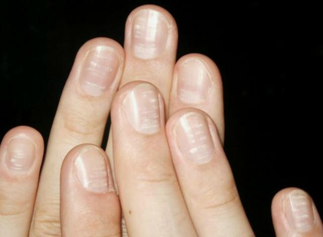Если внешний вид ваших ногтей каким-либо образом отличается от нормального; особенно с точки зрения формы, размера или цвета, то это знак, на который стоит обратить внимание.